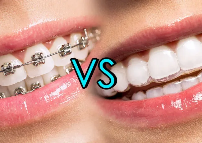 Invisalign vs Traditional Braces
