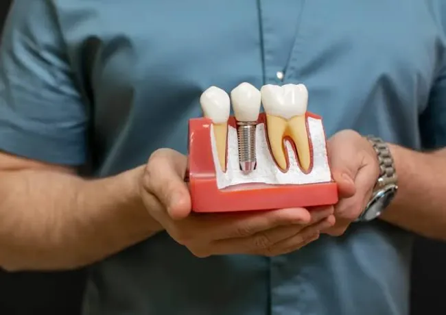 Dental Implant Aftercare Tips for a Smooth Recovery
