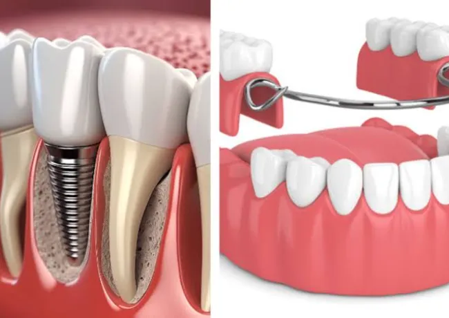 Dental Implants vs. Dentures: Which Is Right for You?